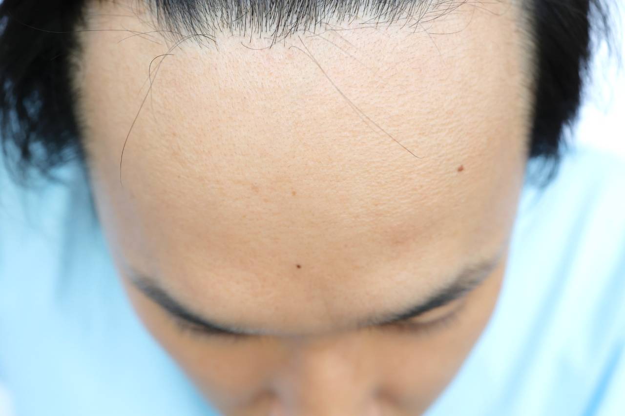【男性専用】薄毛・AGA治療で育毛サプリの効果が驚くほど！