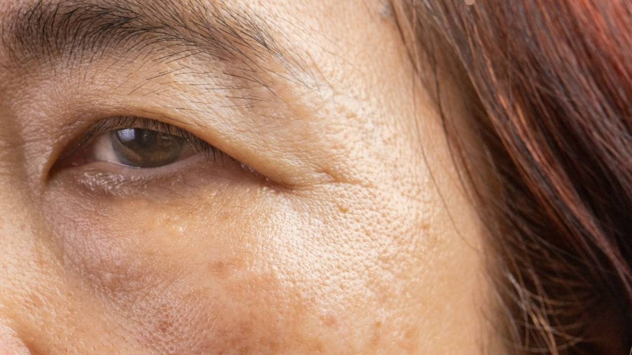 シミ・そばかす・肝斑・ADM でお悩みの方へ